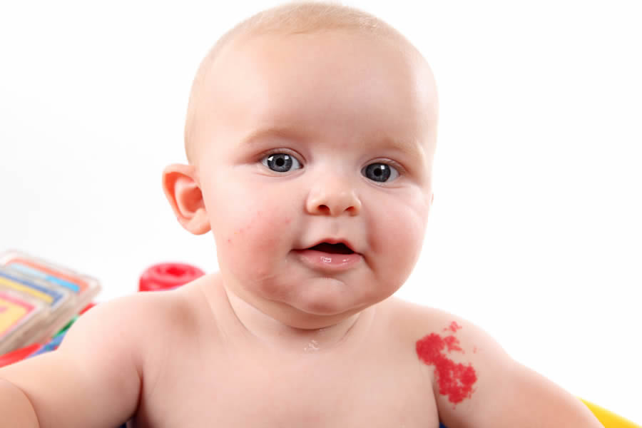 Baby with strawberry birthmark